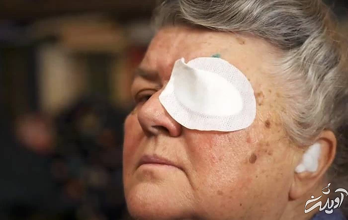 فواید لیزیک چشم چیست ؟ لیزیک چشم